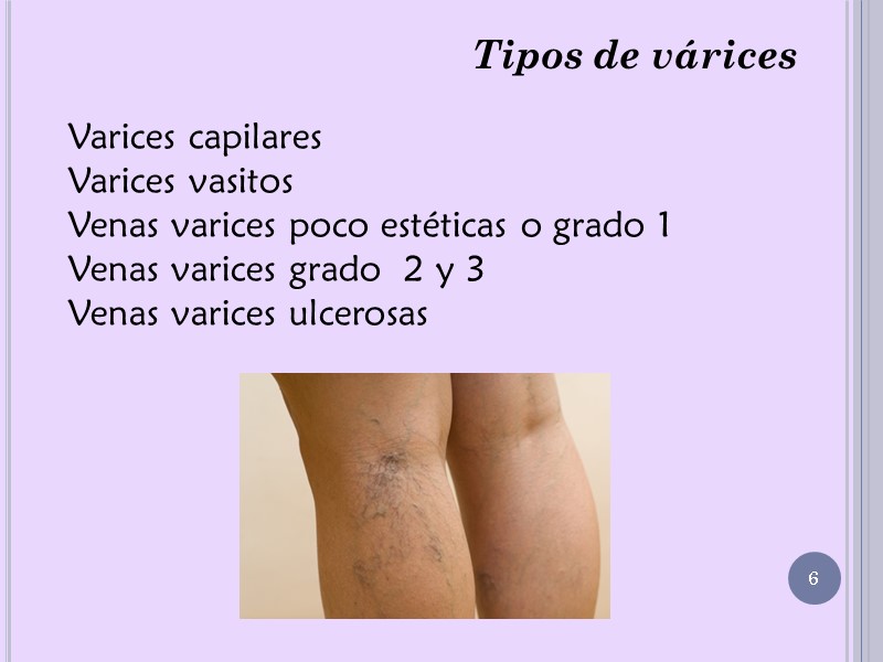 Tipos de várices Varices capilares Varices vasitos Venas varices poco estéticas o grado 1
